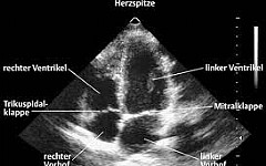 Darstellung der Herzstrukturen im Ultraschall